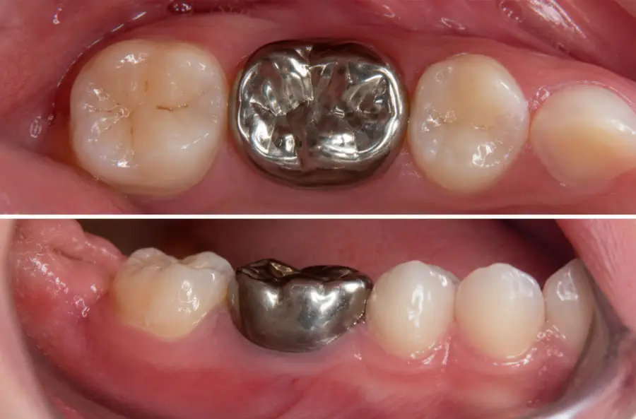 STAINLESS STEEL CROWNS (SSC)